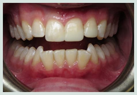 Chipped Tooth Repair, after