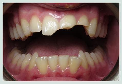 Chipped Tooth Repair, before