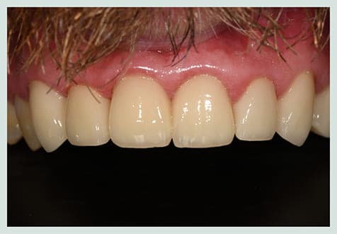 Smile Makeover, after
