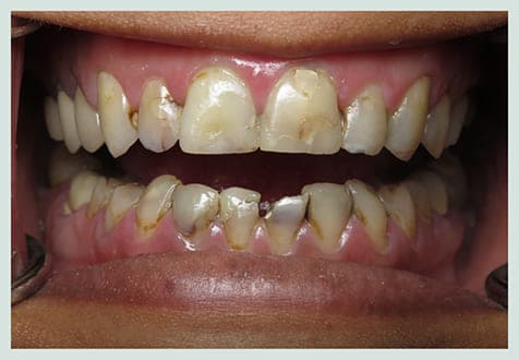 Smile Makeover, before
