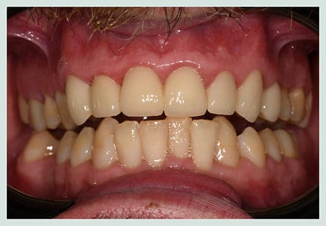 Smile Makeover II, after