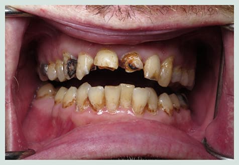 Smile Makeover II, before