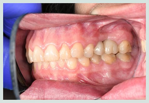 Dental Implants, after