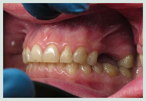 Dental Implants, before