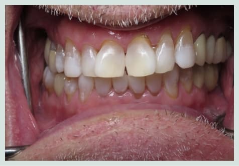 After: Professional teeth whitening results