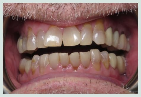 Before: Professional teeth whitening results