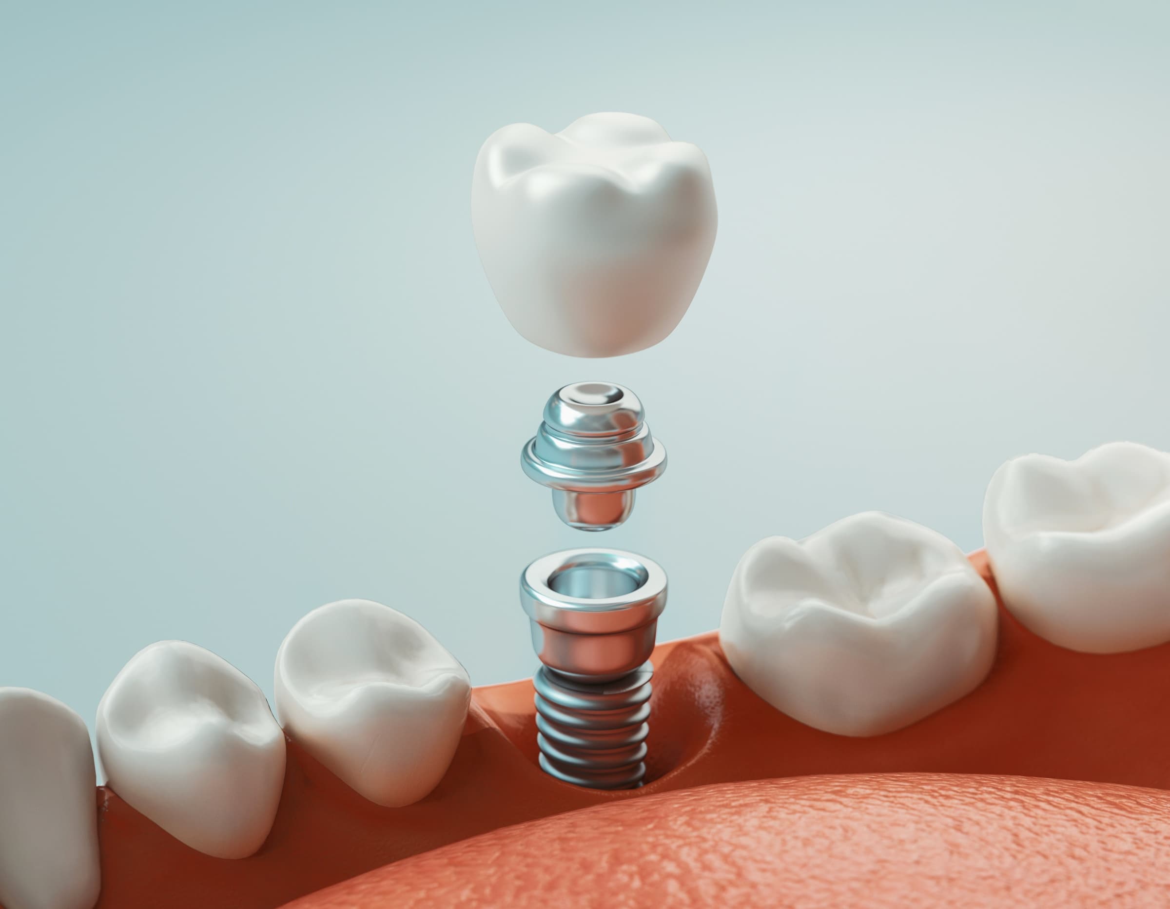 A ceramic dental implant crown displayed on a neutral background