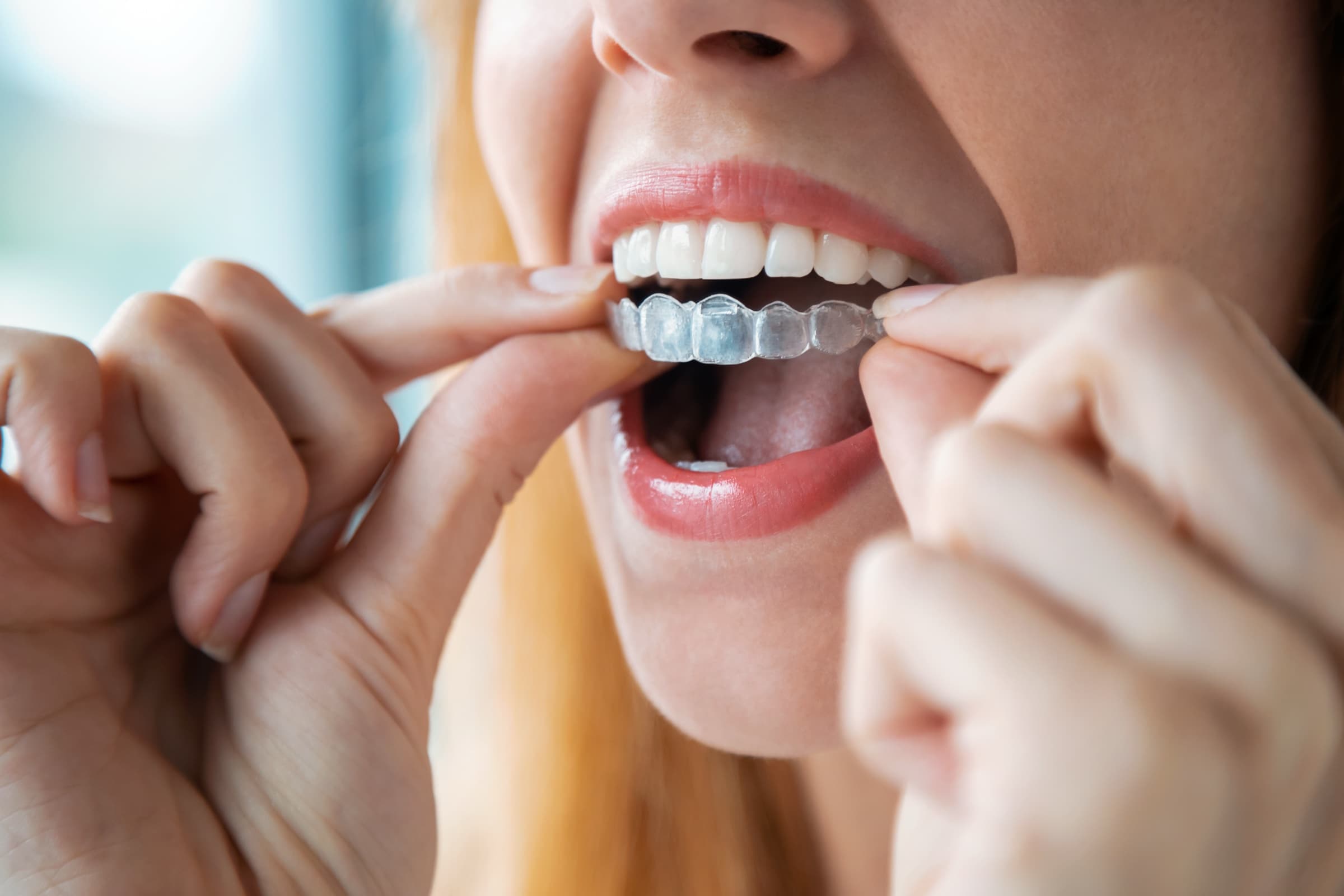 A clear Invisalign aligner tray held up to the light