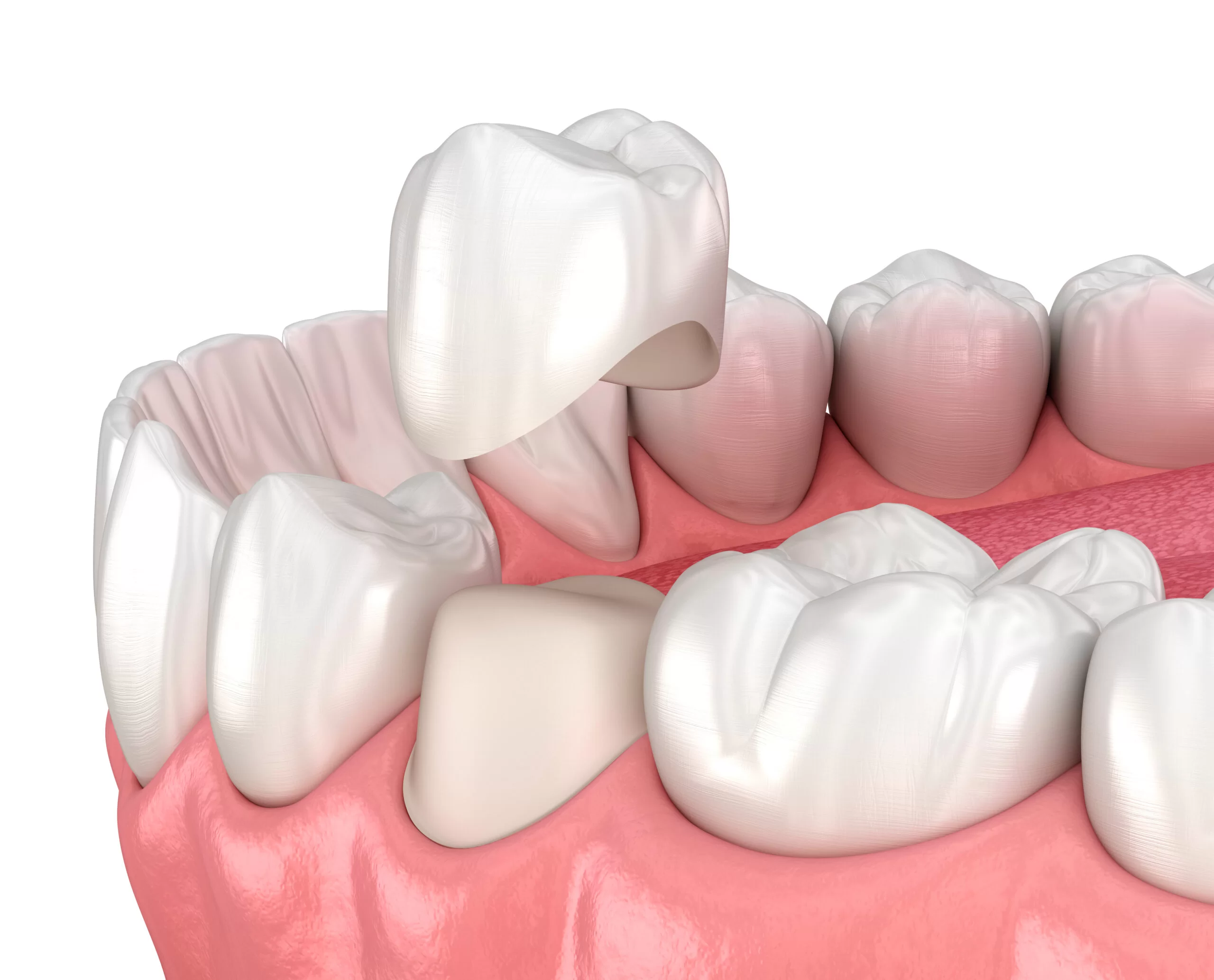 A dental crown being seated onto a prepared tooth