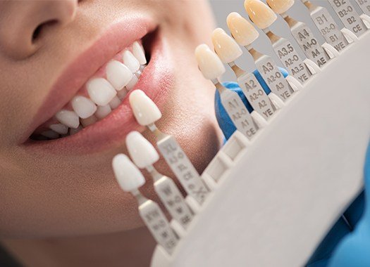 Smile compared with tooth shade chart