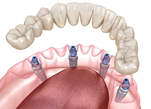 A digital image of a customized lower denture being secured over All-On-4 dental implants