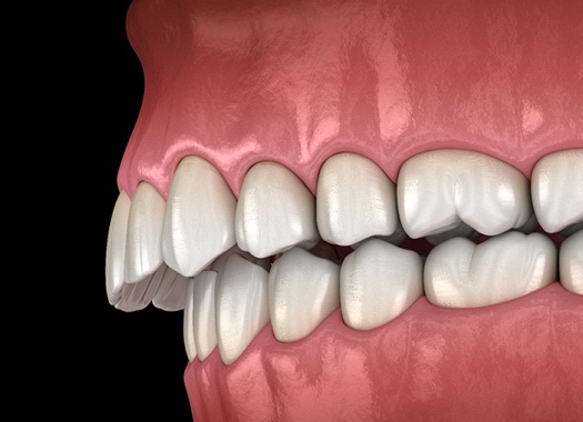 Digital image of an overbite with the top teeth protruding out over the bottom teeth