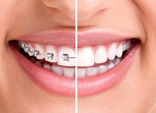 Side by side comparison during and after braces in Uptown New Orleans