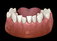 Diagram of crooked teeth before braces