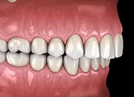 Diagram of overbite before braces