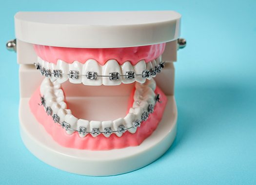 A mouth mold, complete with braces in Uptown New Orleans