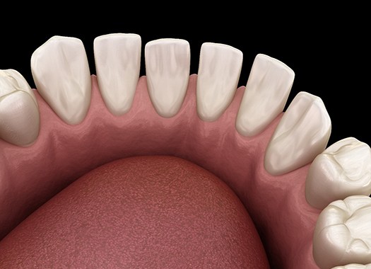Digital image of a bottom row of teeth that have spaces between each one