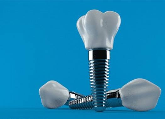 closeup of dental implants in New Orleans