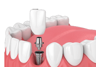 Dental implant special coupon