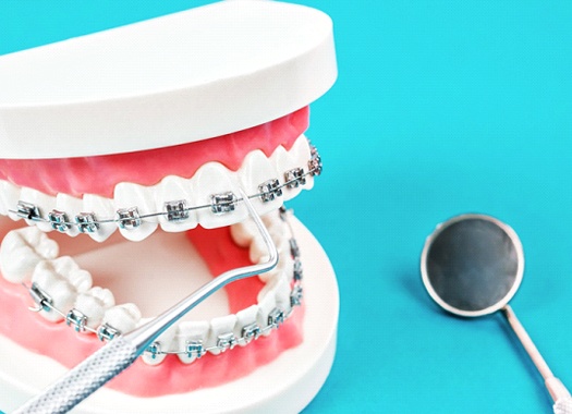 A mouth mold with braces and dental instruments