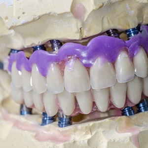 a plaster model of a mouth featuring implant dentures