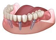 Implant dentures in New Orleans on white background