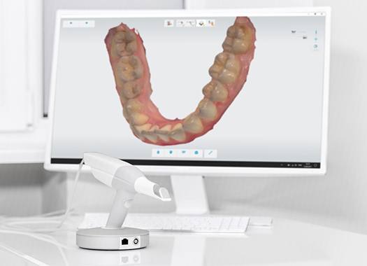 Digital impression scanner in front of computer monitor