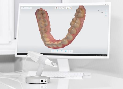 Digital impression scanner in front of computer monitor 