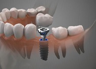 dental implant illustration