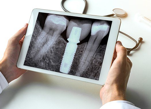 X-ray of implant supported replacement tooth