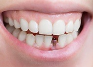 Closeup of smile with dental implant post in place