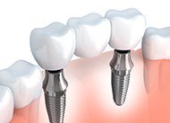Animation of implant supported fixed bridge