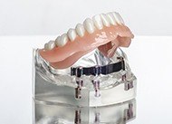 Model of implant supported denture