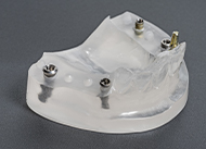 Model jaw line with all-on-4 implants set up