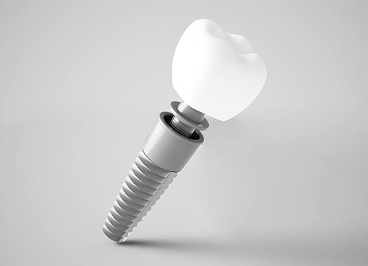 Animation of dental implant parts