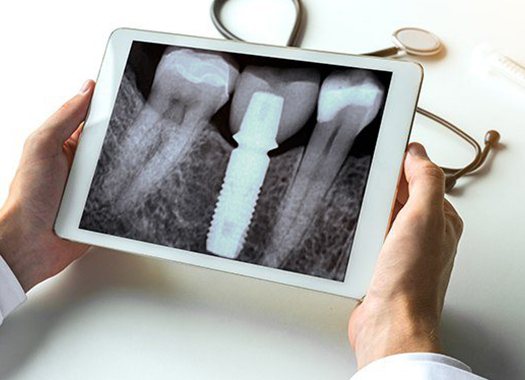 dentist looking at an X-ray of a patient with dental implants on a tablet 