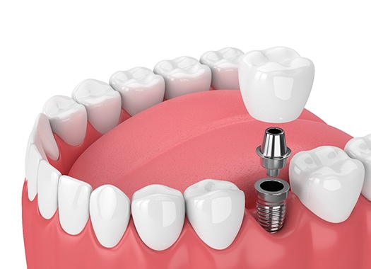 dental implant being placed in the lower jaw 