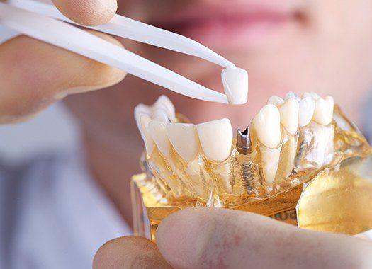 An up-close view of a dentist holding a customized dental crown in preparation for placing it on top of an implant designed for a patient who recently received information concerning the cost of dental implants in New Orleans