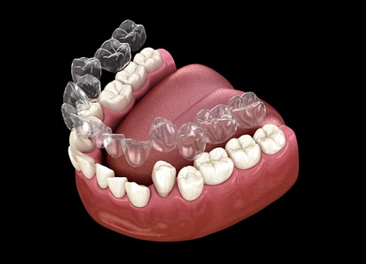 Invisalign correcting crooked teeth in Uptown New Orleans