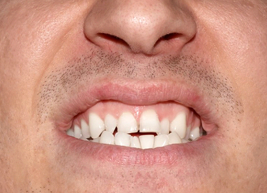 A man with crowded and crooked teeth.