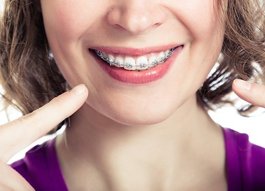 Woman with braces pointing to smile