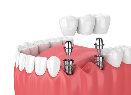 A diagram of an implant-retained bridge in Uptown New Orleans.