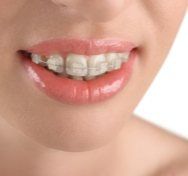 Closeup of smile with tooth-colored braces