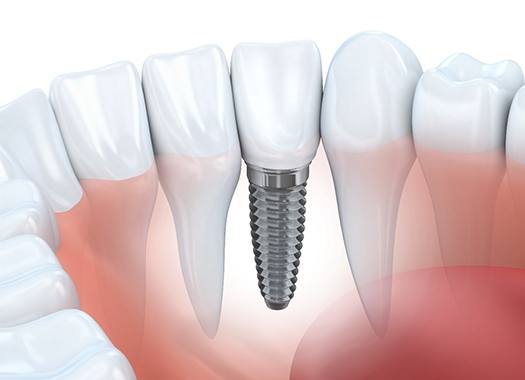 Diagram of a single tooth implant in Uptown New Orleans.