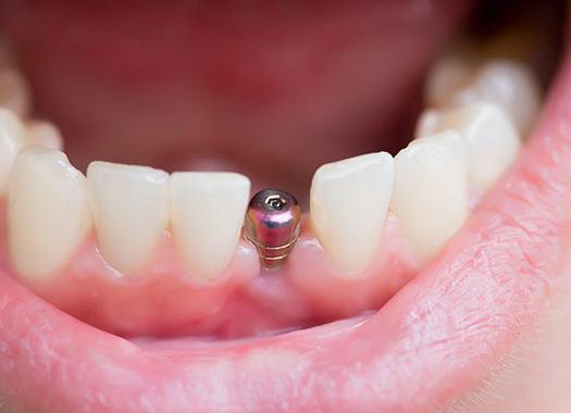 Closeup of a mouth with an unrestored dental implant.