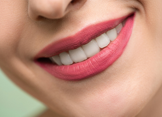 Woman’s teeth after smile makeover in New Orleans