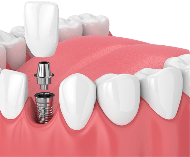 Dental implant special coupon