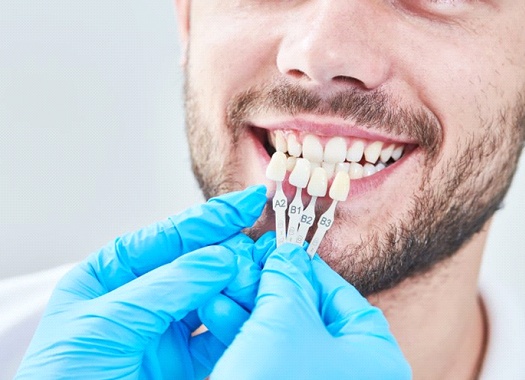 man getting fitted for veneers