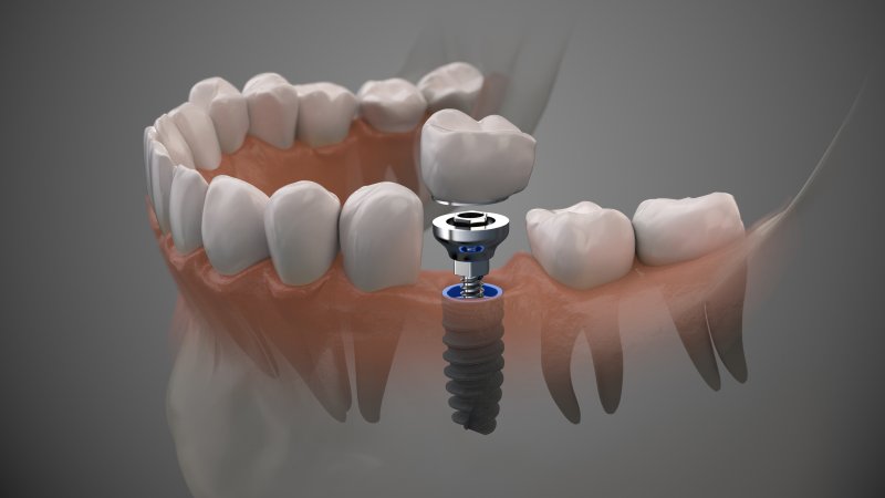 a digital image of a single tooth dental implant in Uptown New Orleans after a tooth extraction