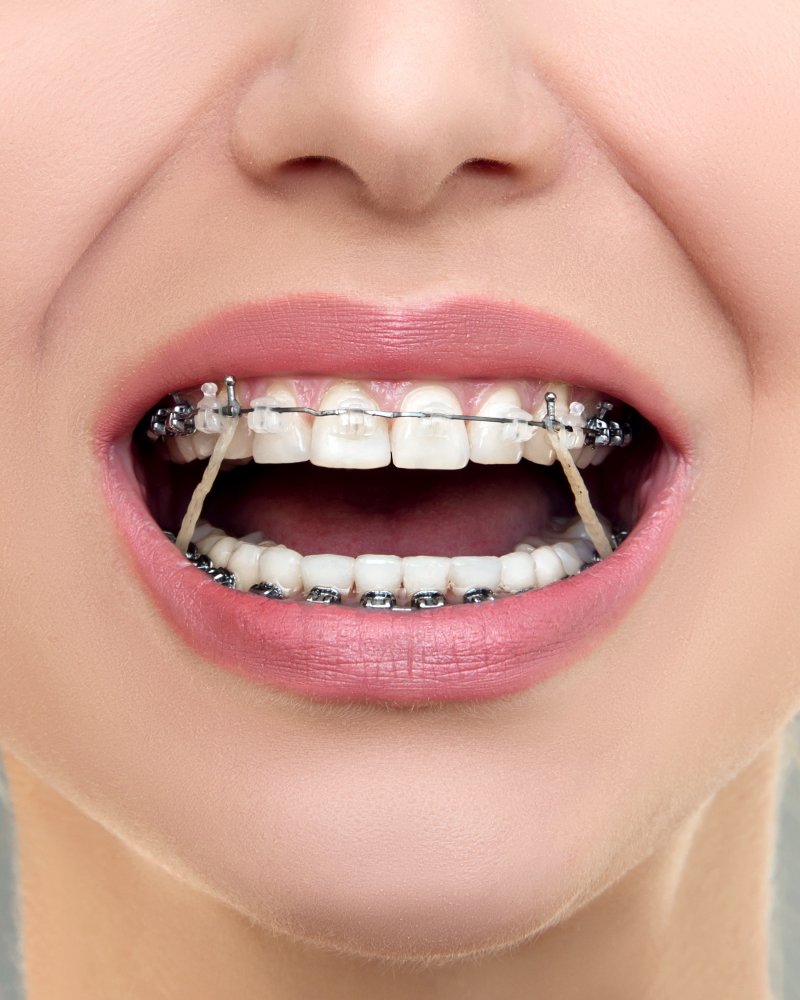 an up-close image of a person wearing rubber bands on braces in Uptown New Orleans